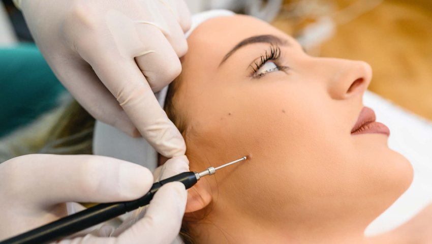 Top Mole Removal Treatment Options: Laser, Surgery, and More